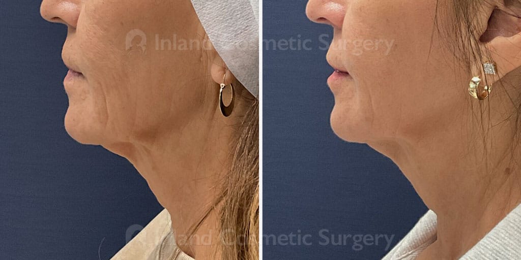 Matrix RF Microneedling