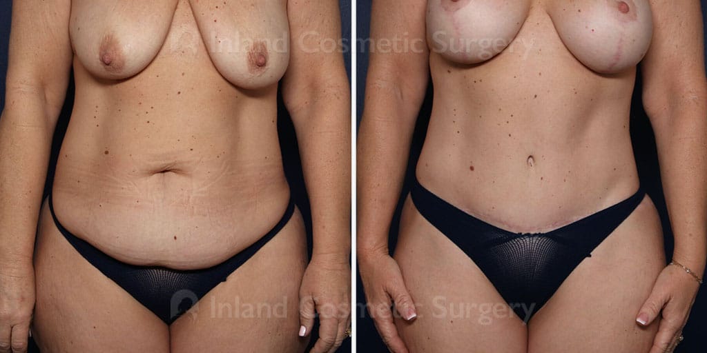 Tummy Tuck with Liposuction