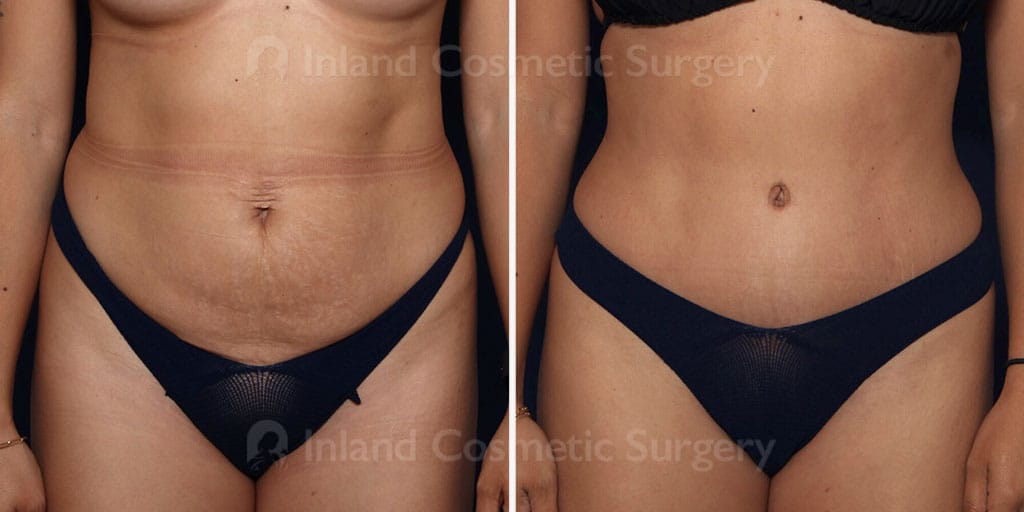 Tummy Tuck with Liposuction