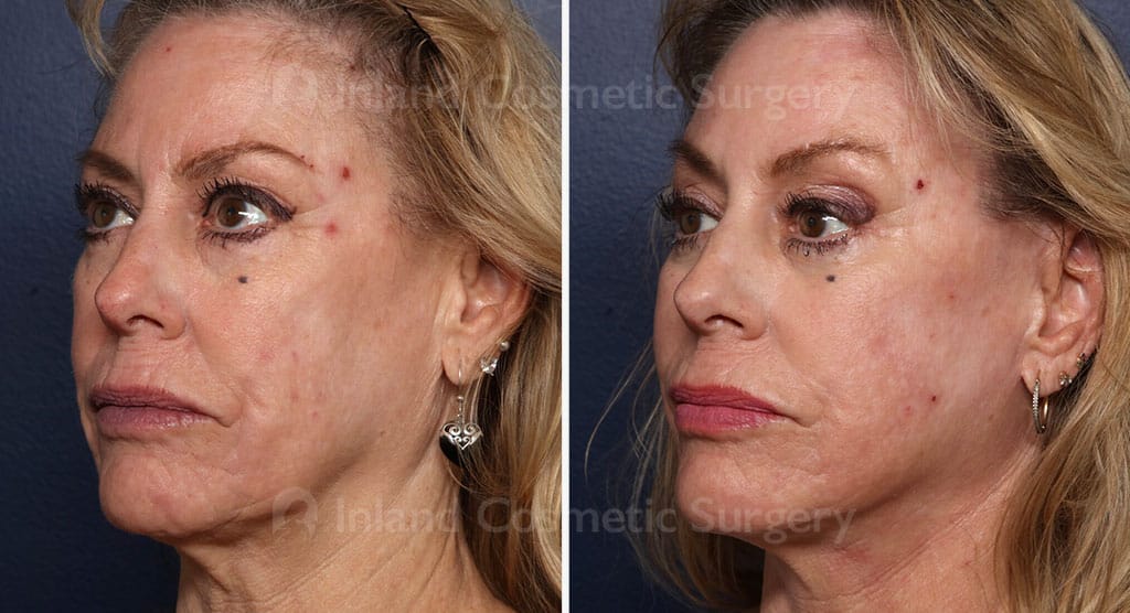 Facial Rejuvenation Multi Procedures