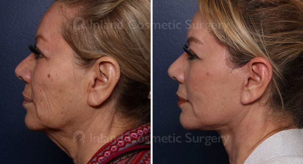 Face Multiple Procedures