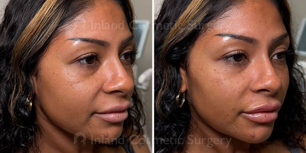 Injectable Fillers