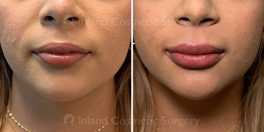 Lip Augmentation