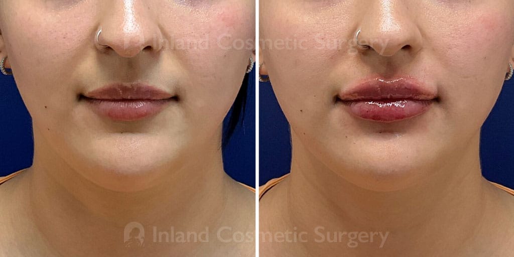 Lip Augmentation