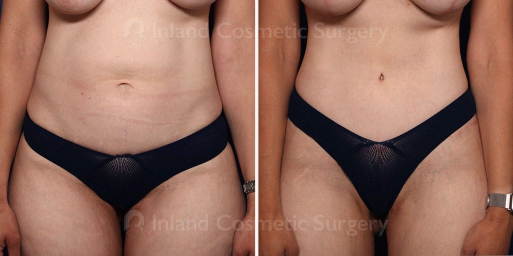 Tummy Tuck