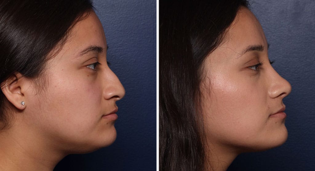 Rhinoplasty