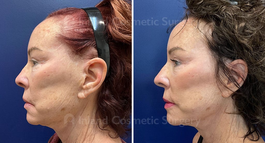 Profound Skin Tightening