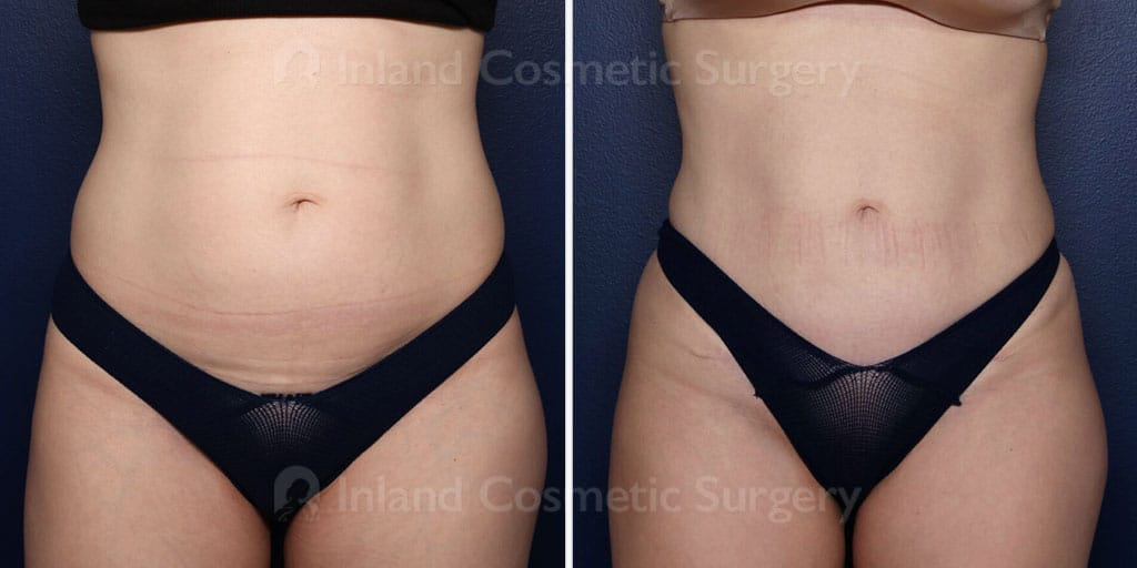 Mini Tummy Tuck with Liposuction