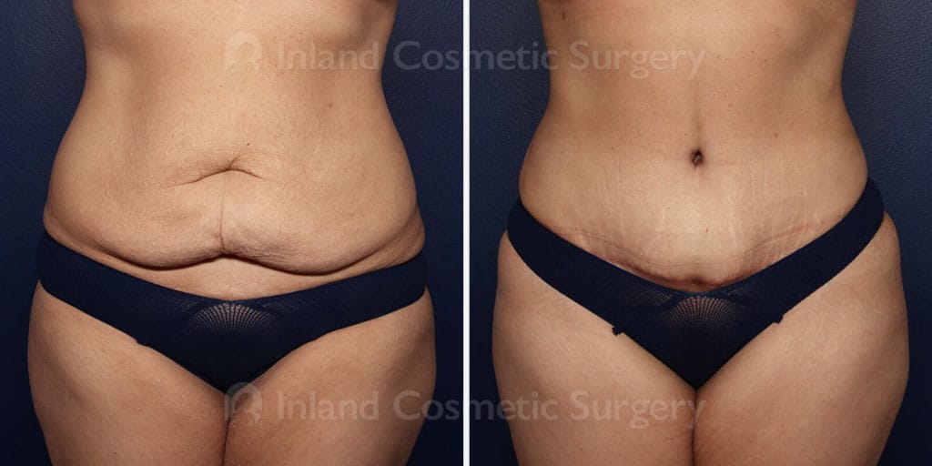 Tummy Tuck with Liposuction