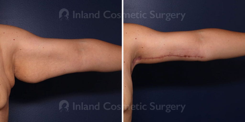 Upper Arm Lift