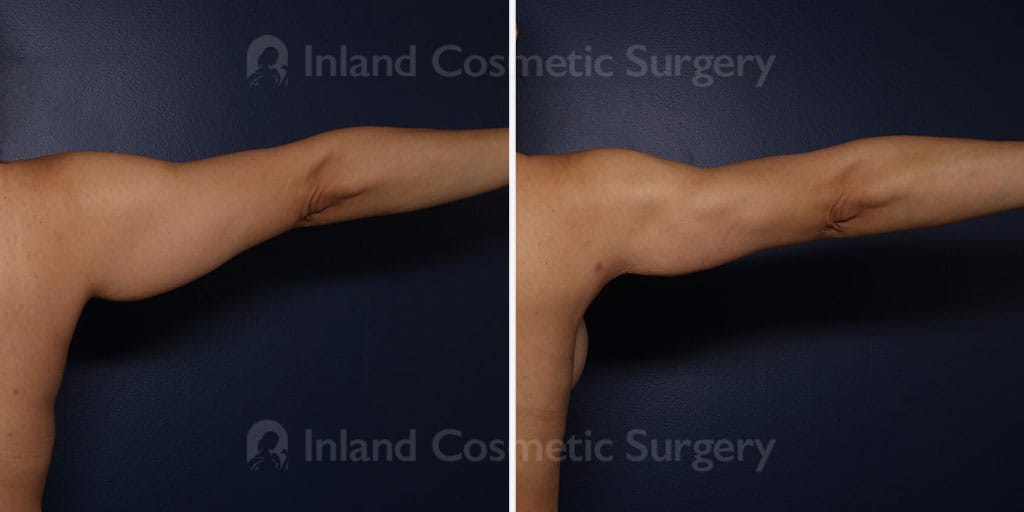 Upper Arm Liposuction