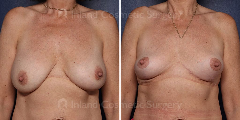 Breast Implant Removal with Lift
