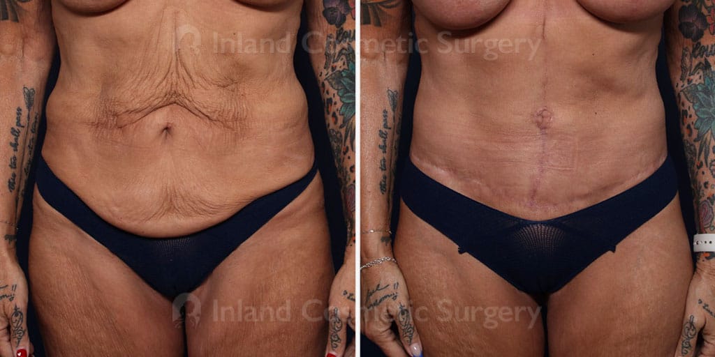 Tummy Tuck