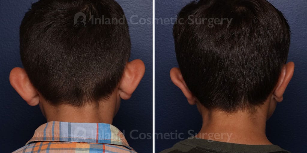 Otoplasty
