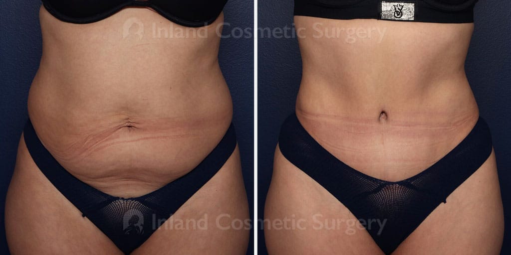 Tummy Tuck with Liposuction