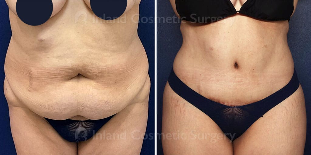 Tummy Tuck with Liposuction