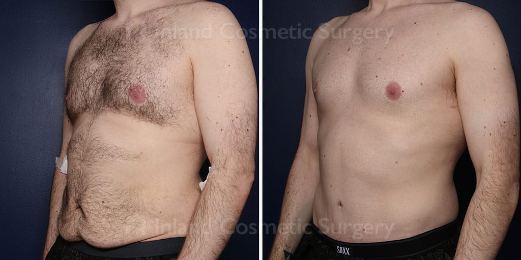 body-lift-30109b-inlandcs