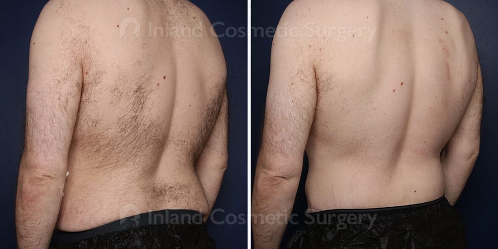 body-lift-30109c-inlandcs