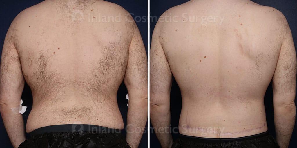 body-lift-30109d-inlandcs