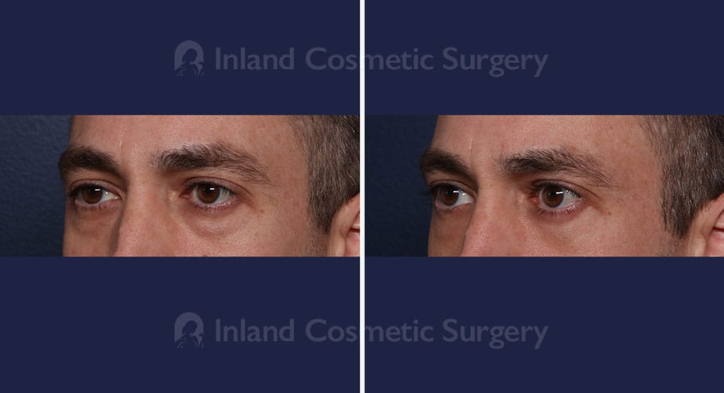Eyelid Surgery Male