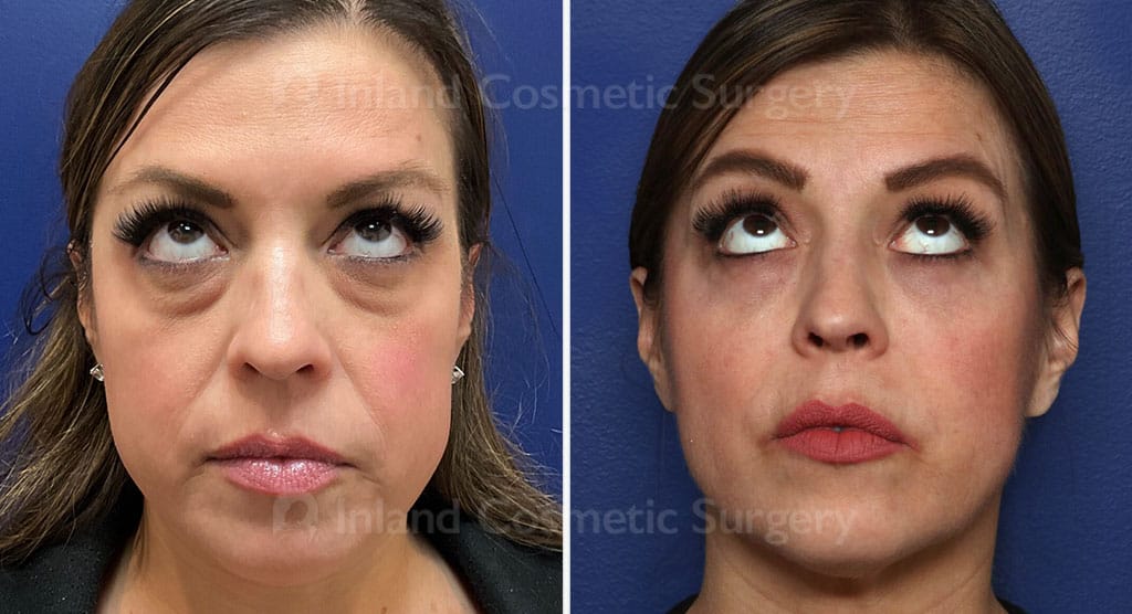 eyelid-surgery-lower-30125a2-inlandcs