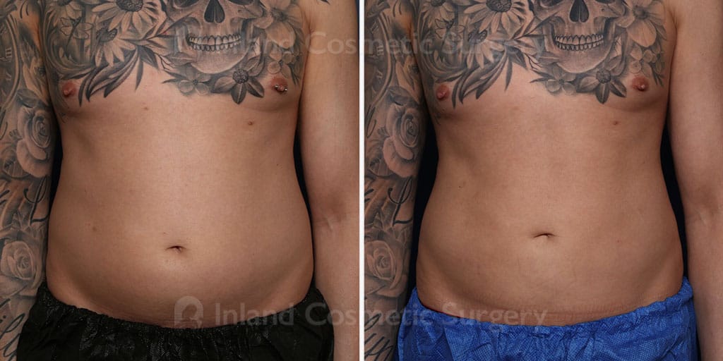 Liposuction Male