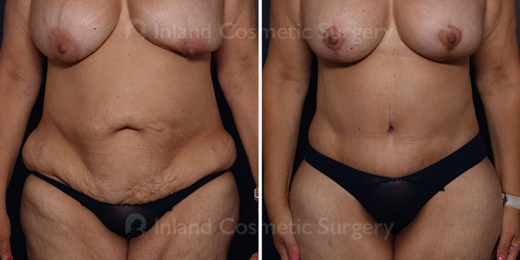 Tummy Tuck with Liposuction