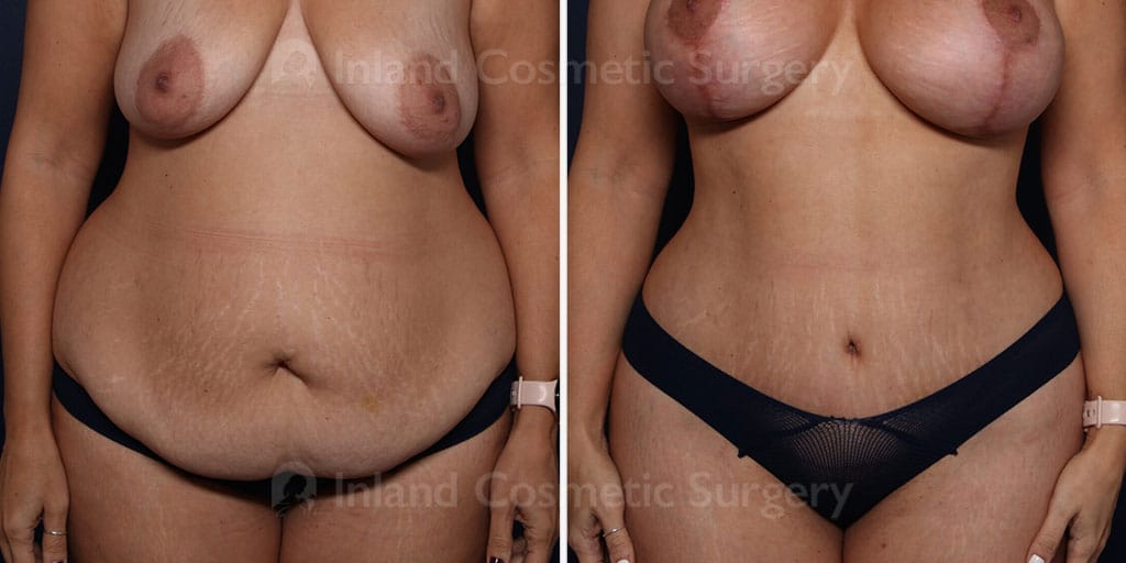 Tummy Tuck