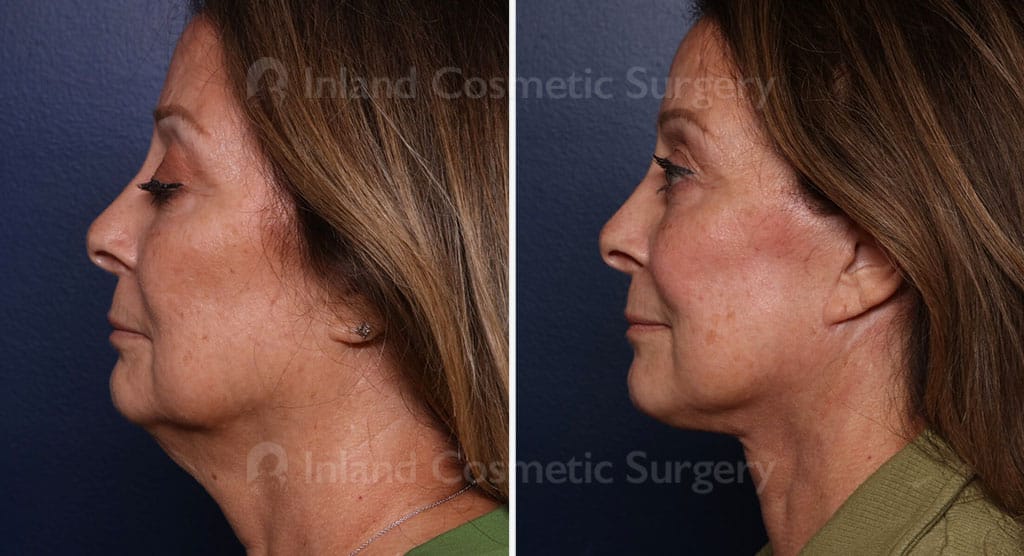Facelift & Neck Lift