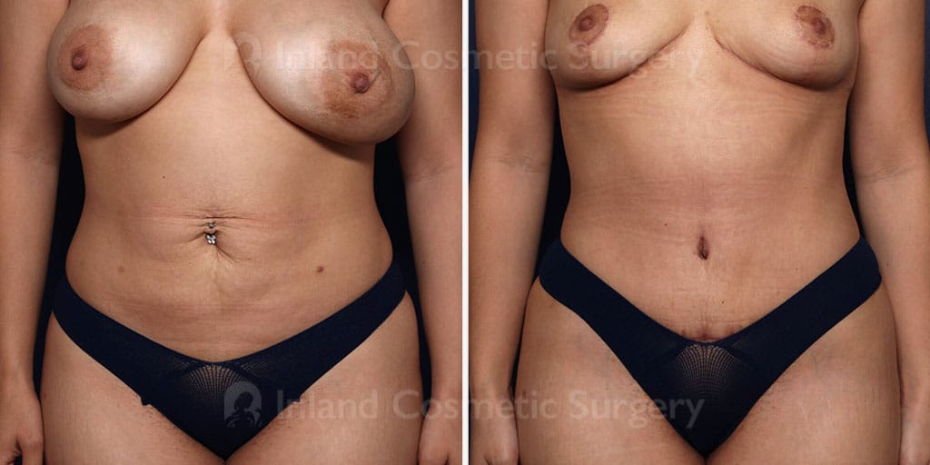 Tummy Tuck