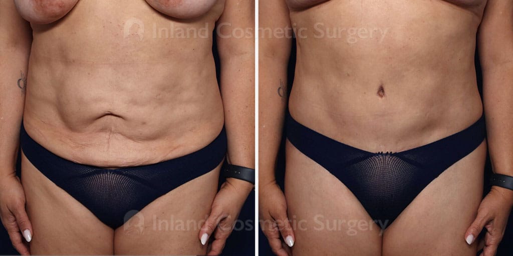 Tummy Tuck