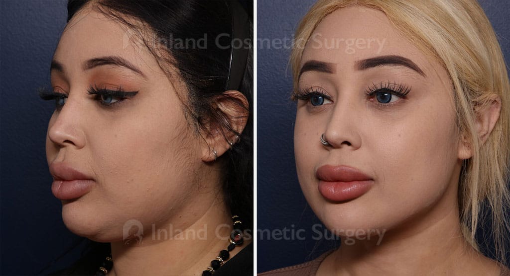 Submental Liposuction