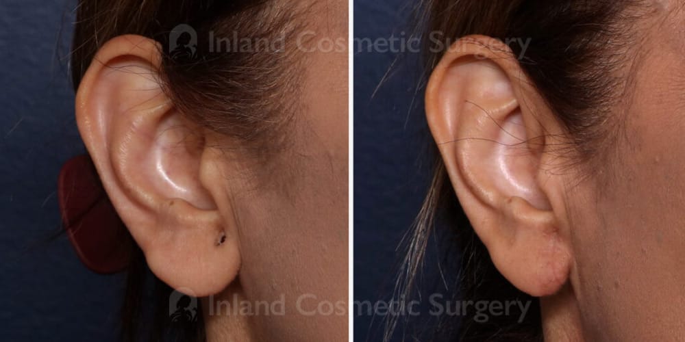 Scar Revision Earlobe