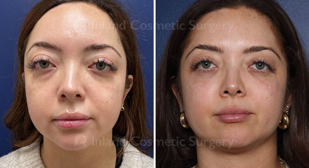 Eyelid Surgery