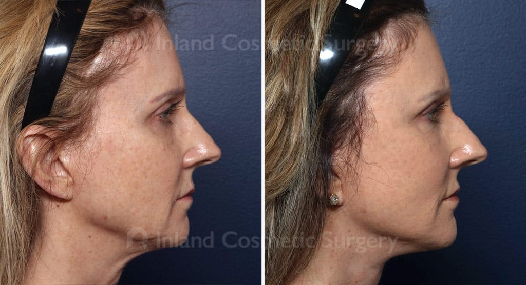 Facial Rejuvenation Multi Procedures