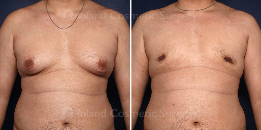 Male Breast Reduction