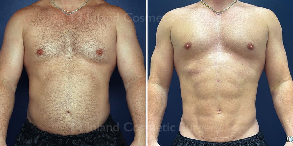 Vaser Liposuction Male