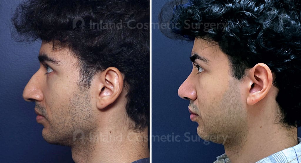 Rhinoplasty Male