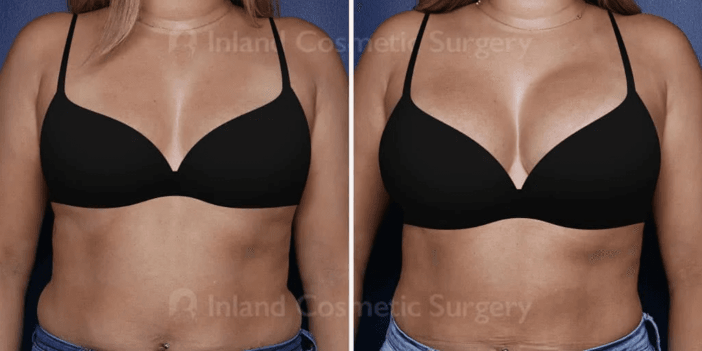 Before and after TUBA (Transumbilical Breast Augmentation) breast augmentation in Rancho Cucamonga with Dr. Jacob Haiavy