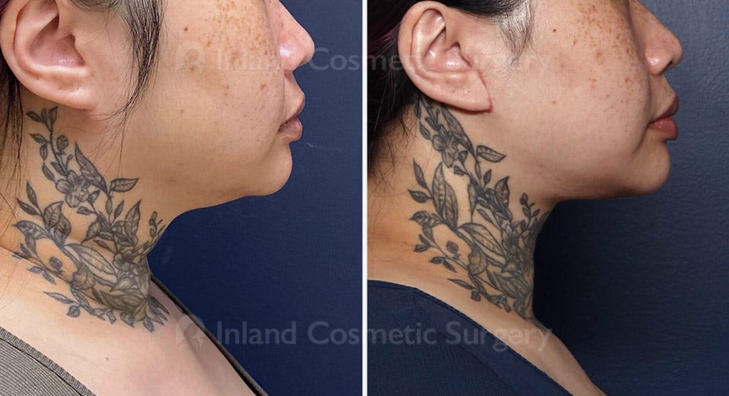 Neck Lift with Liposuction